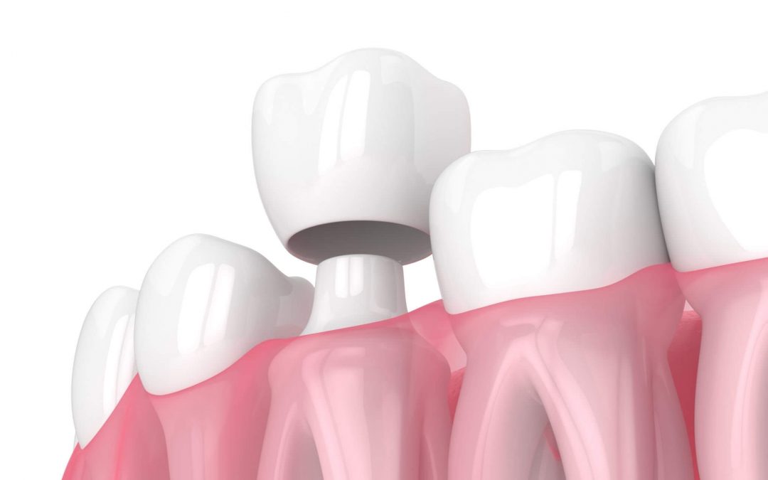 Here are the 5 Material Dental Crown that dentist will suggest to you